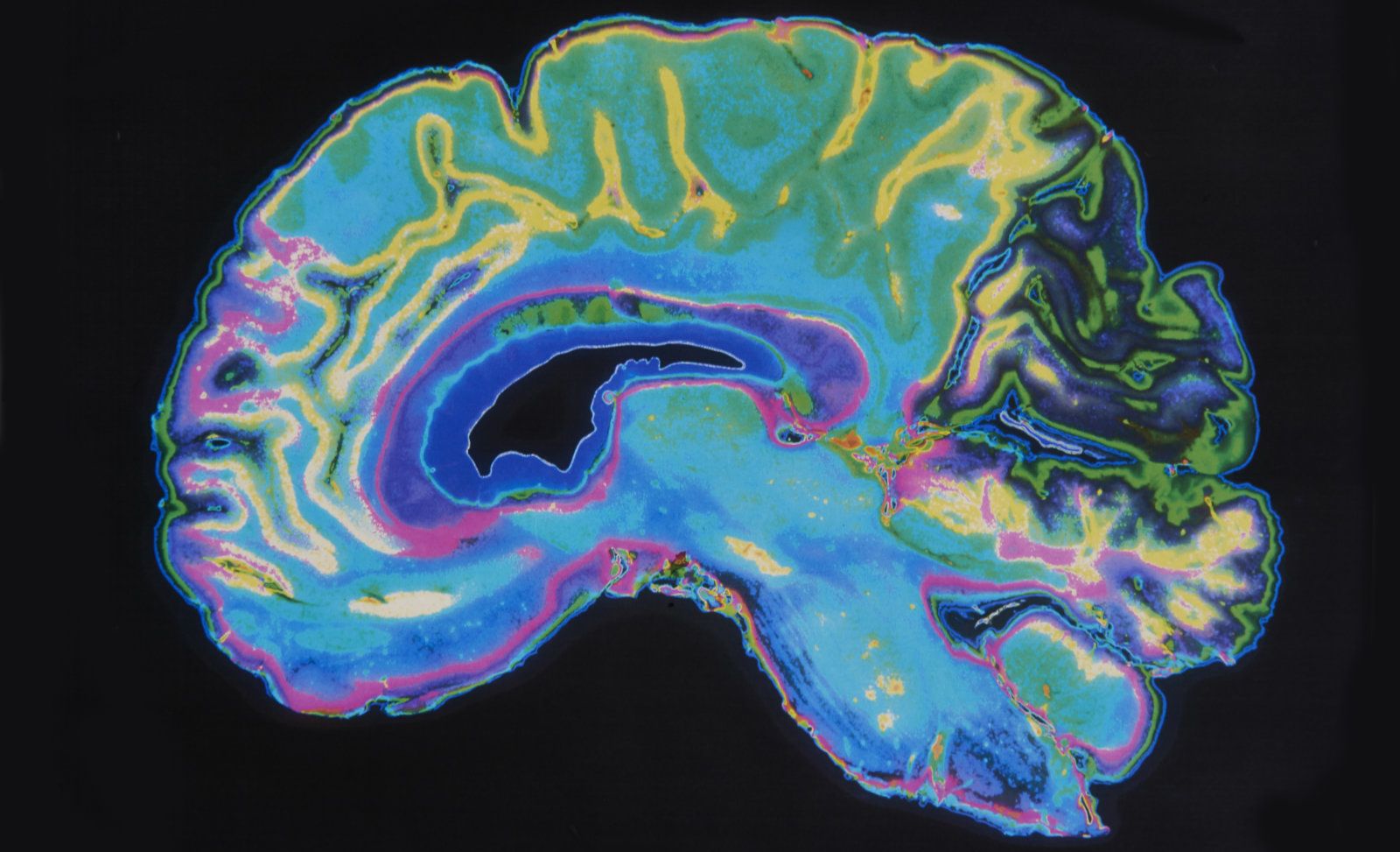 Künstliche Intelligenz gelernt, zu erkennen frühe Anzeichen von Schizophrenie