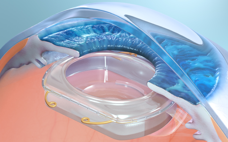 Par la réalité augmentée est maintenant possible de l'implanter directement dans les yeux