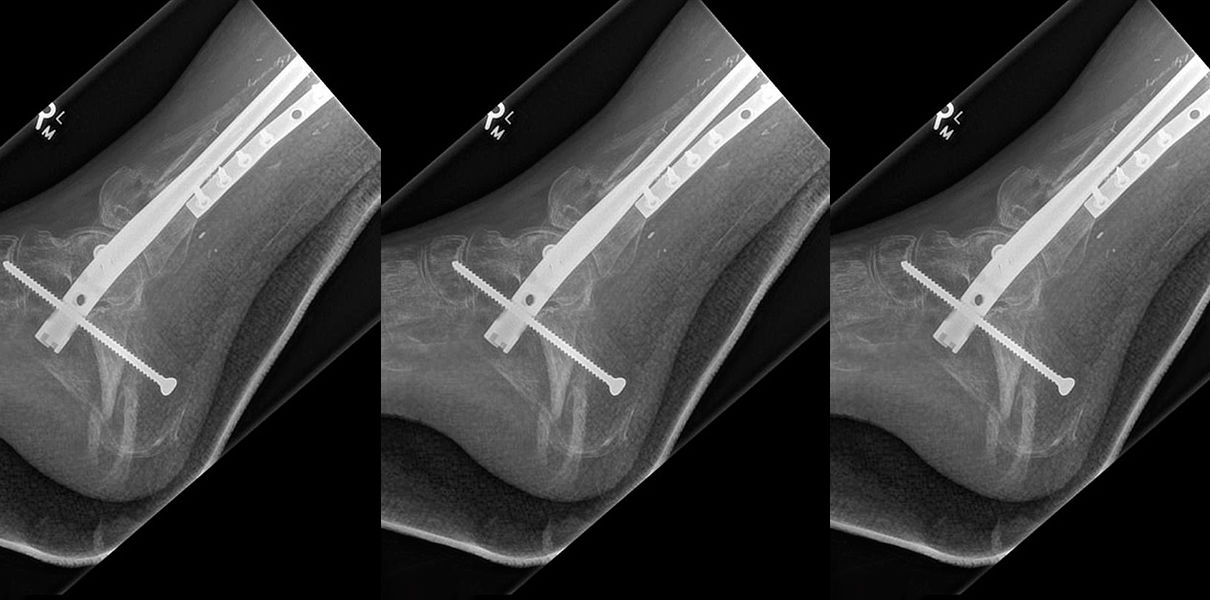 Printed on a 3D printer tibia implanted in the patient