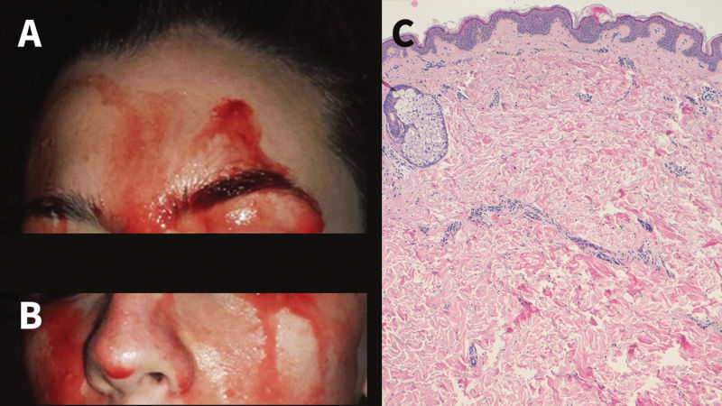 Rare case: patient in Italy sweating blood