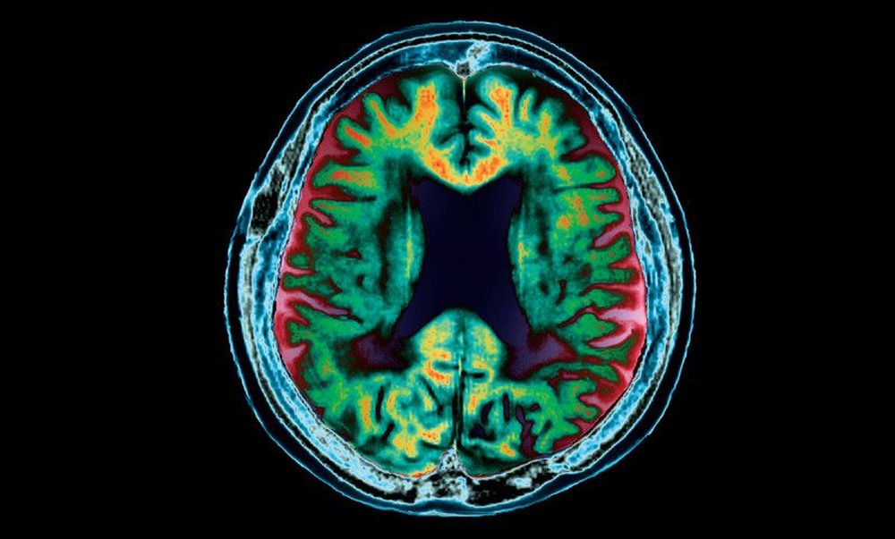 Alzheimers sykdom som kan overføres ved blodoverføring