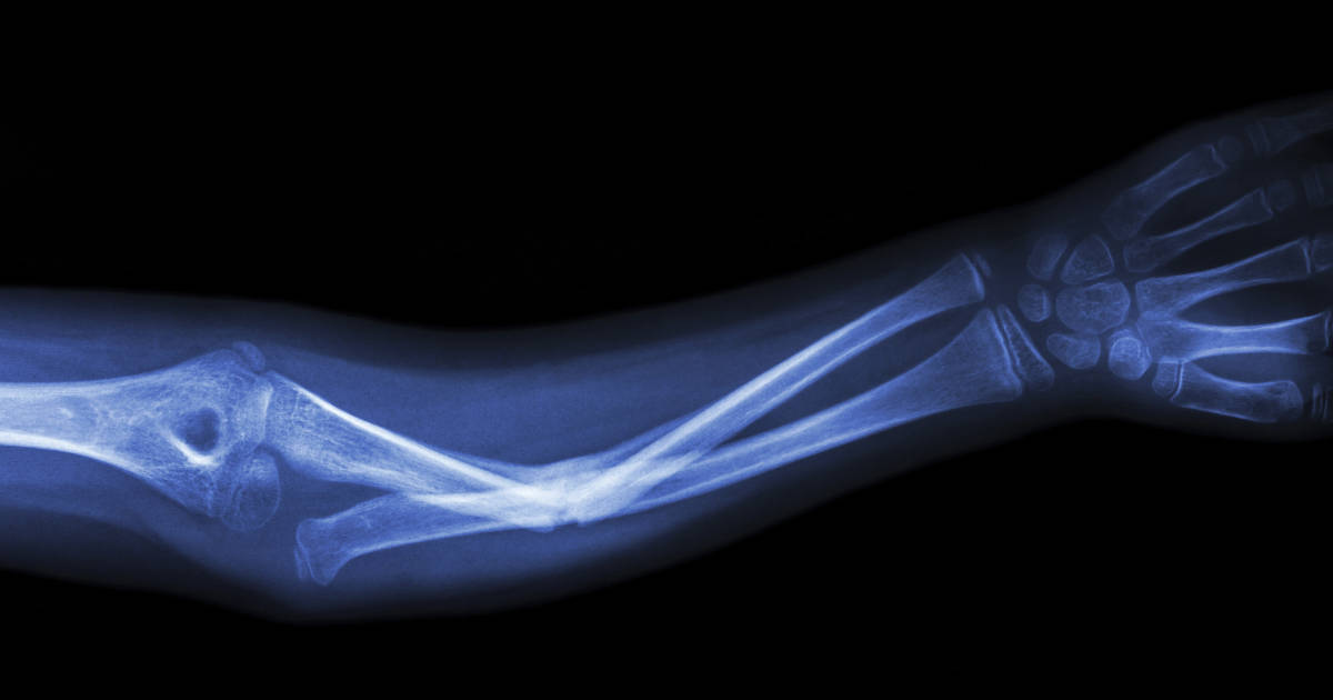 À Sydney développé срастающиеся osseux en céramique implants