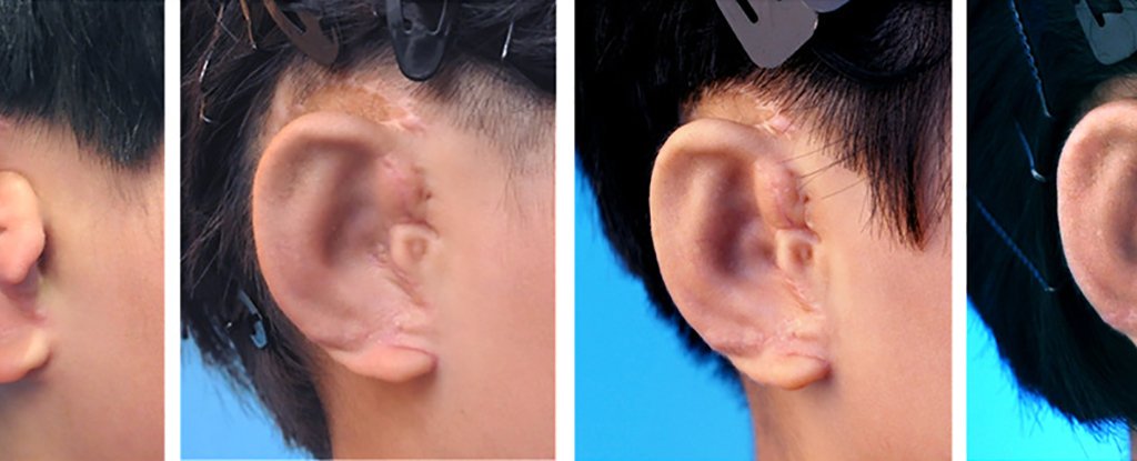 En china llevaron a cabo con éxito únicas de la operación de recuperación de las orejas a los niños