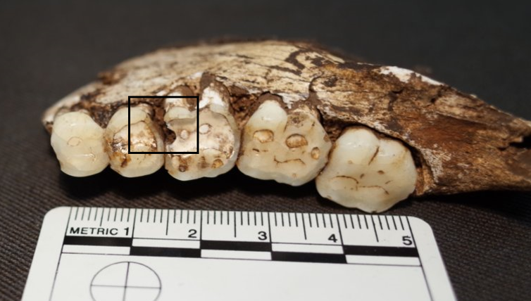 Zucchero a nulla: i nostri antichi antenati erano gli stessi problemi con i denti