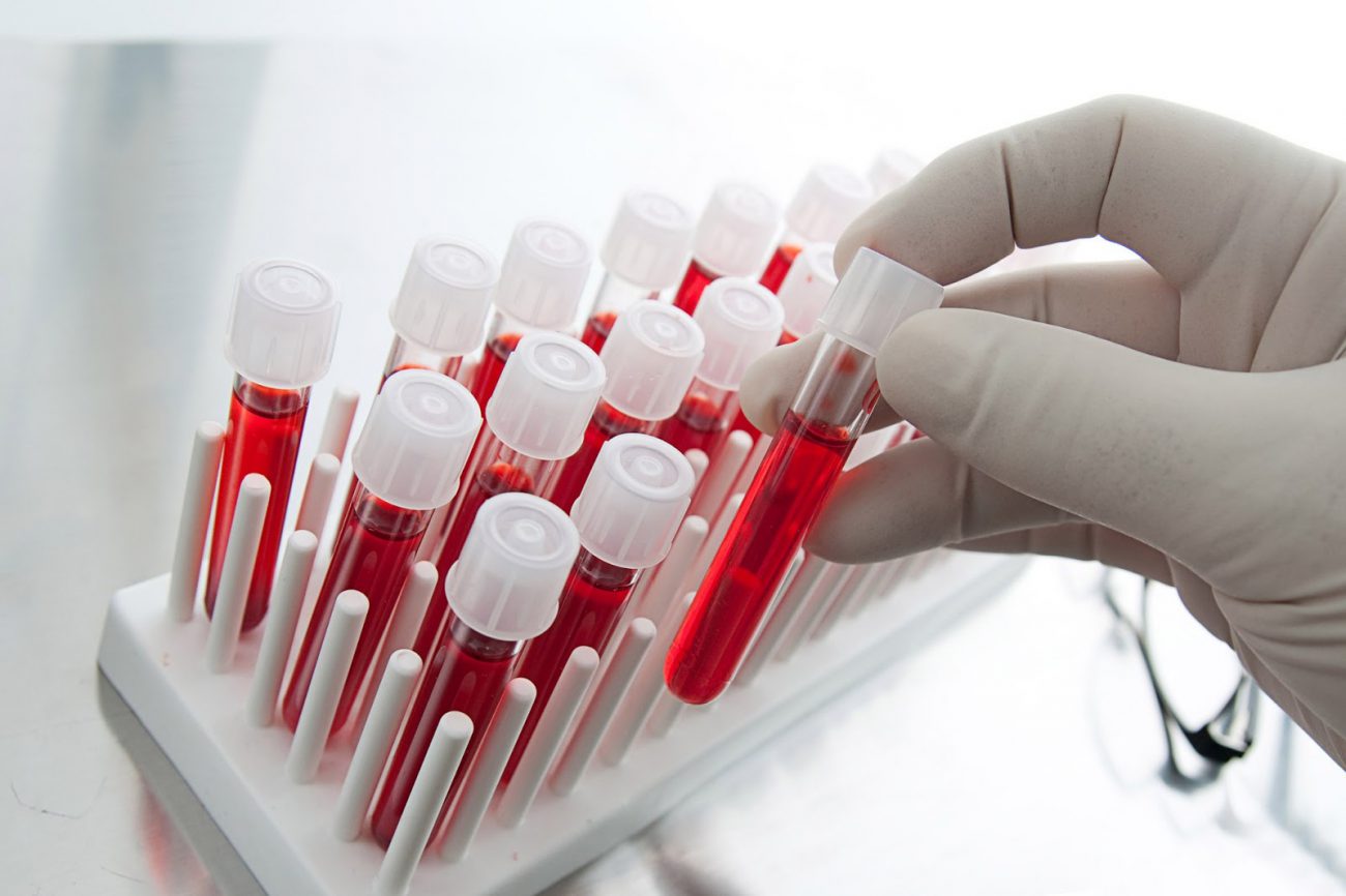Neuer Bluttest hilft zu wissen über das Risiko des Wiederauftretens von Krebs