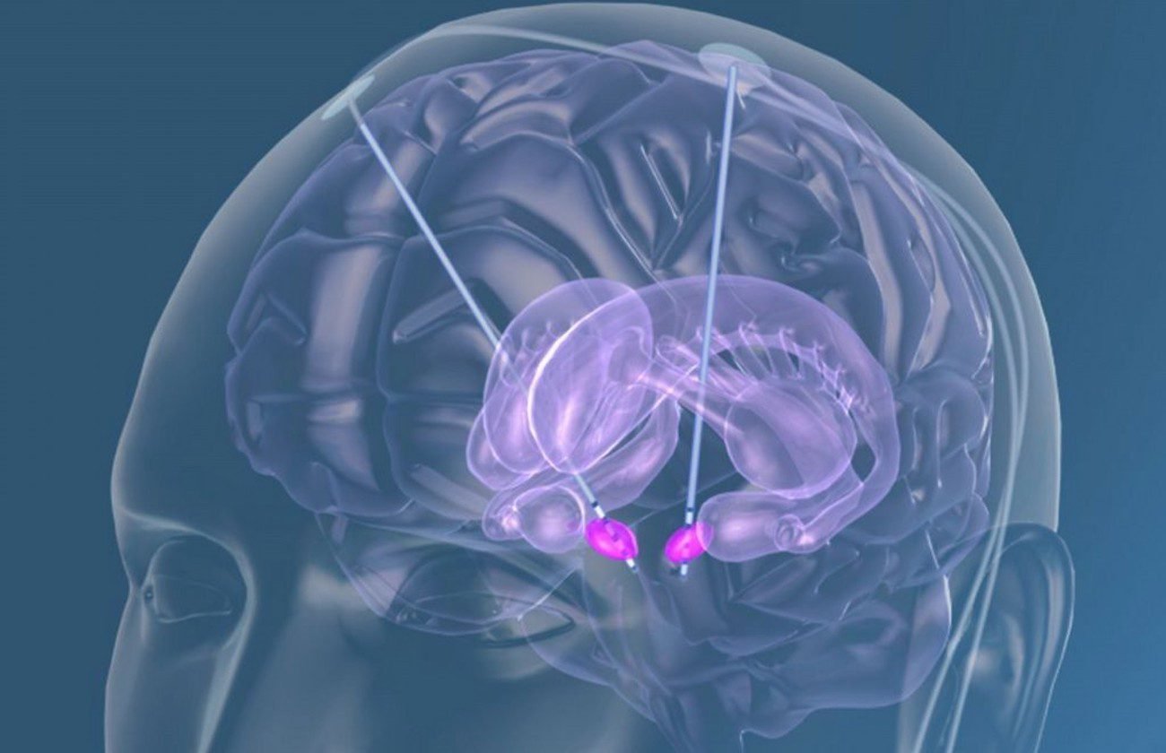 La prima volta gli scienziati hanno ricostruito la memoria nella malattia di Alzheimer