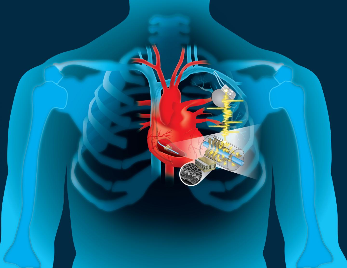 Eternal motor: the energy of the heart can be used to recharge the pacemaker