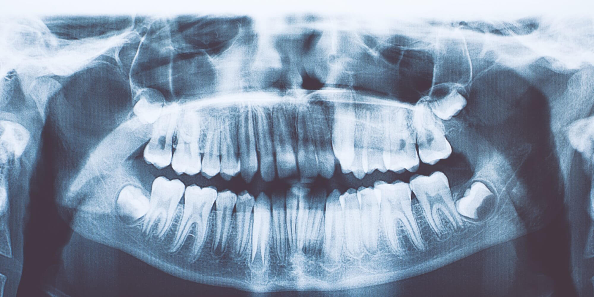 Bei dem indischen Jungen gefunden 526 unnötige Zähne. Was ist das für eine Krankheit?
