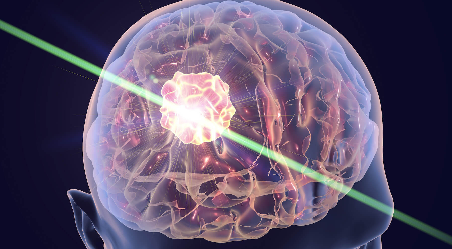 Läkare erbjuder för att behandla Alzheimers sjukdom med laser
