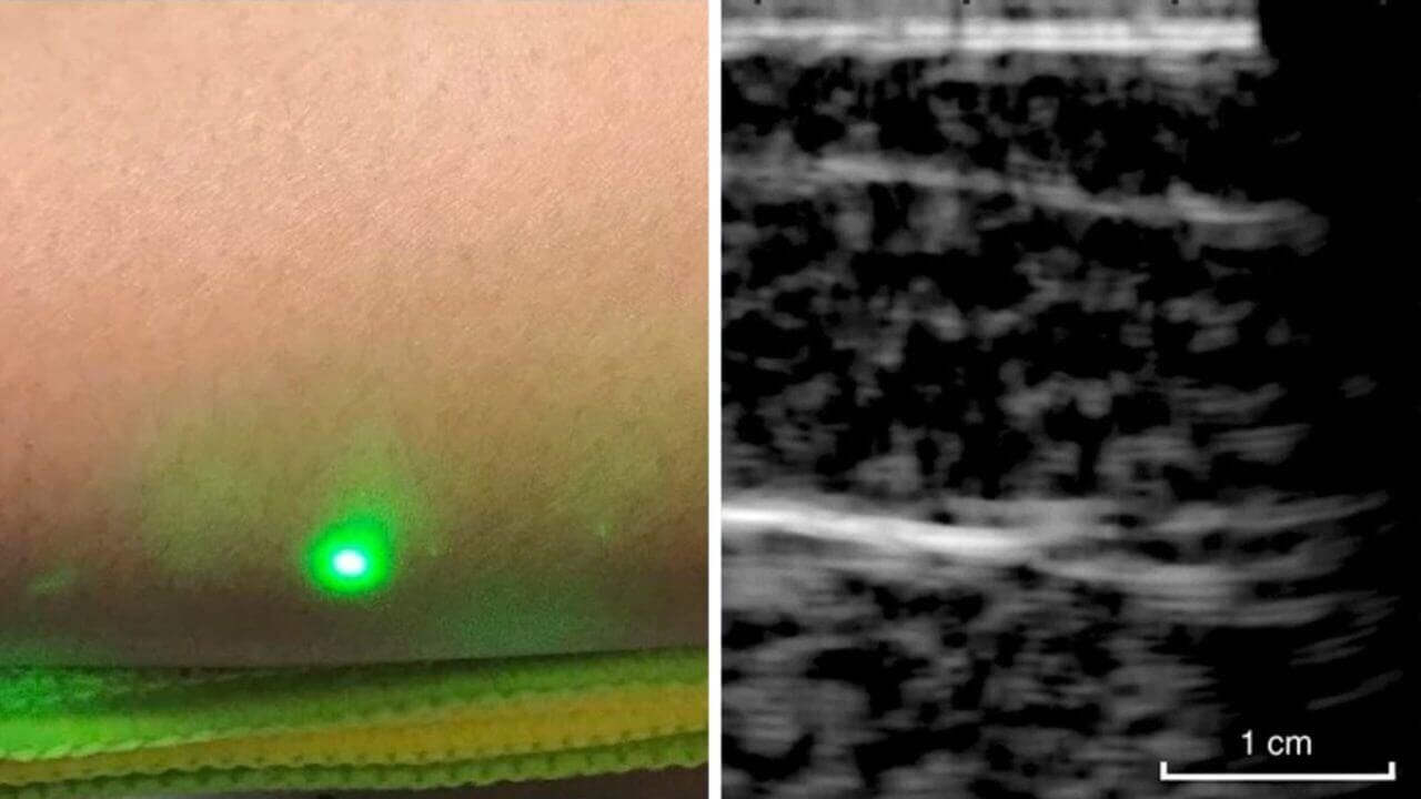 Utrustning för beröringsfri laser ultraljud för första gången testas på människor