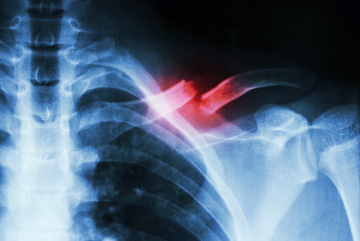 Experimental treatment may help several times faster to mend broken bones