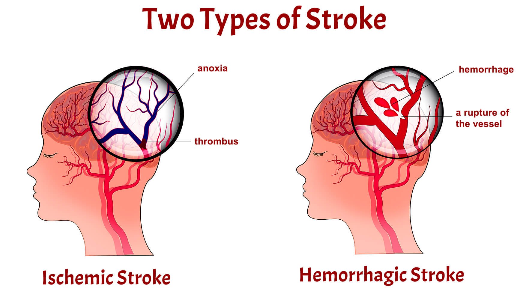 What types of stroke exist and why they happen?