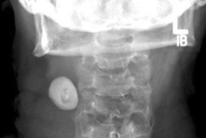 What is a salivary stone and the more dangerous it is?