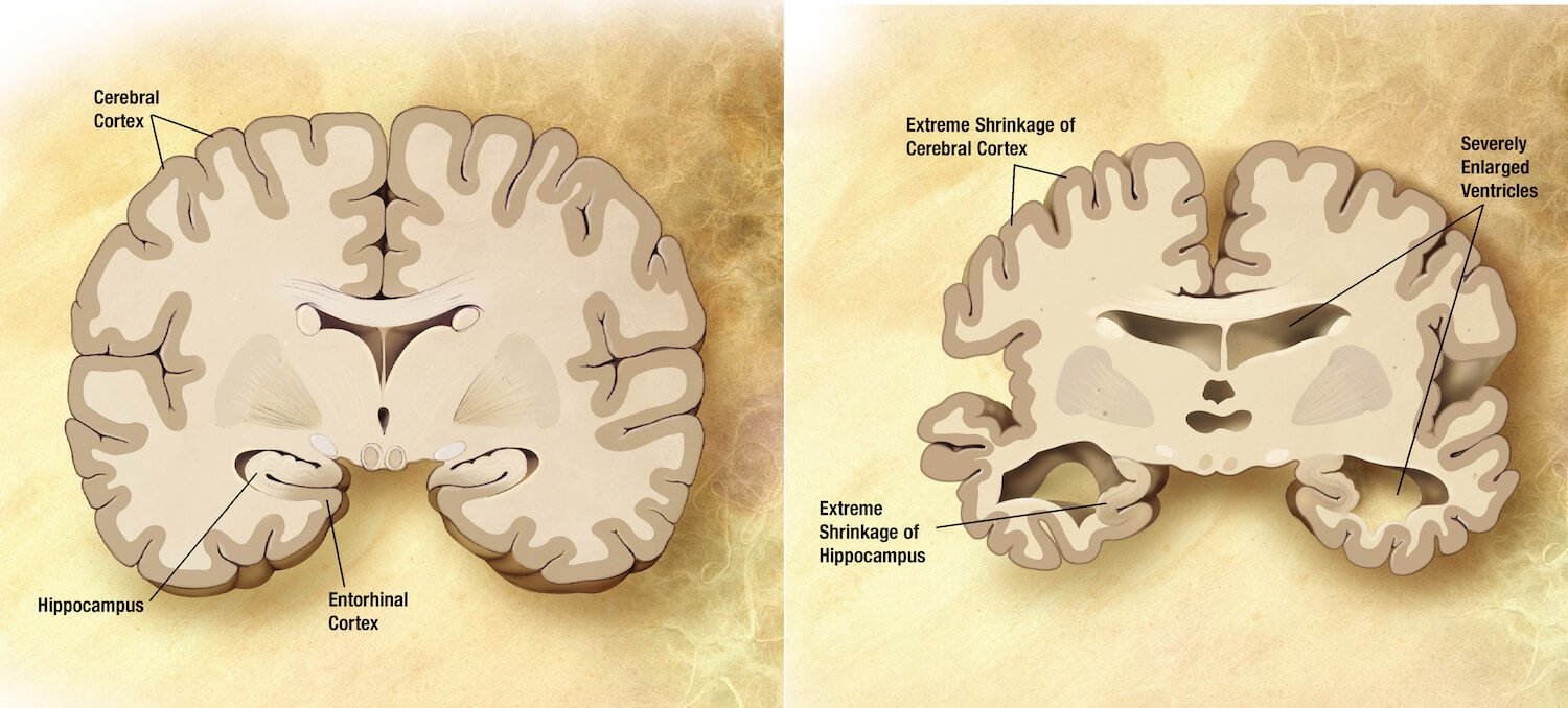 Kan herpesvirus kan orsaka Alzheimers?