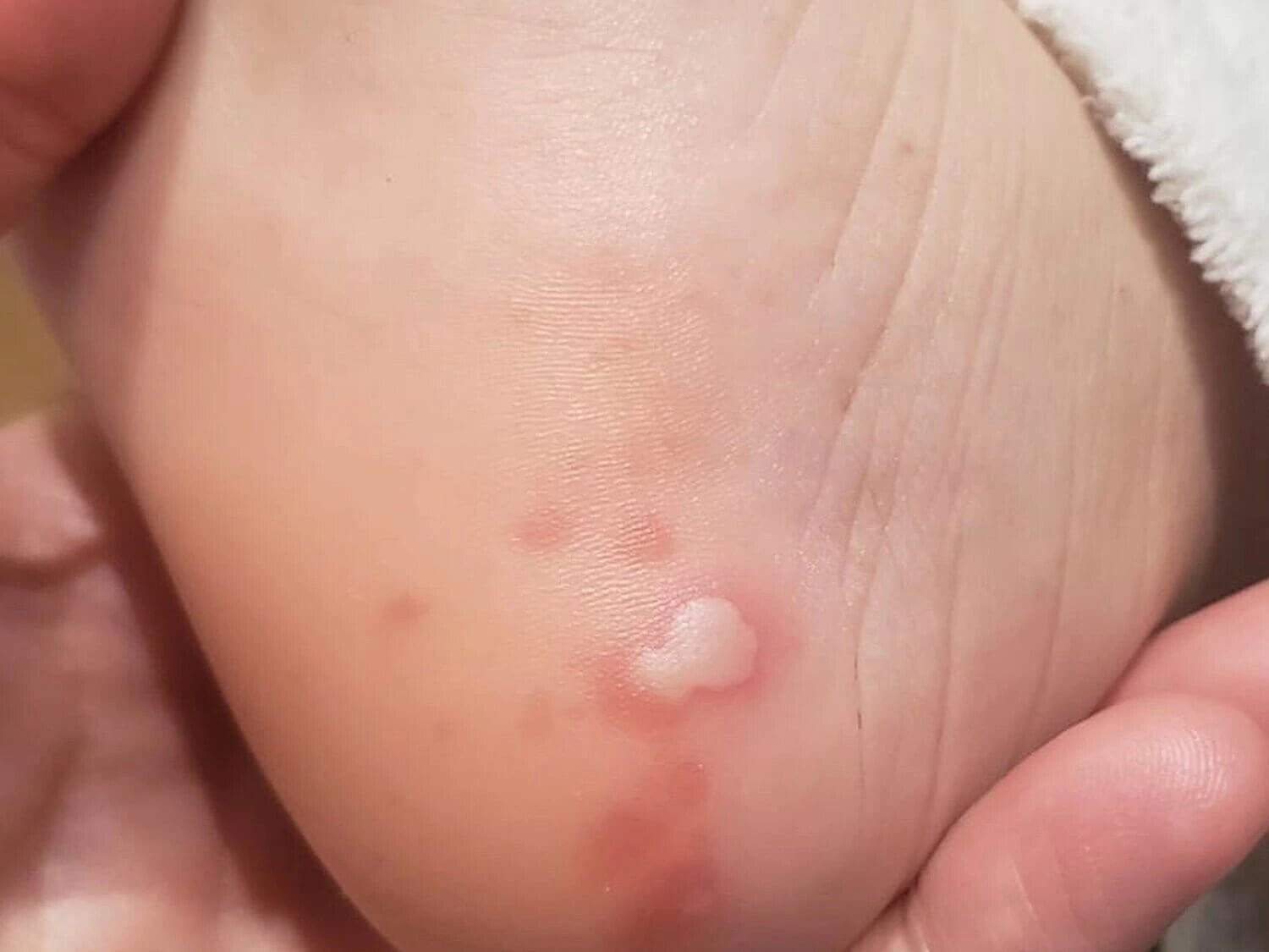 Can skin rash be a symptom of coronavirus?