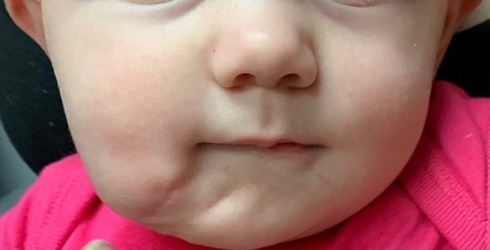 Aux états-UNIS, l'enfant est né avec une deuxième bouche: les chirurgiens ont mené une opération de retrait